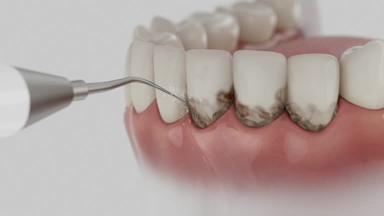 Trusted Dental Crowns And Bridges service in Riviera Beach, MD - Dentist Open Now